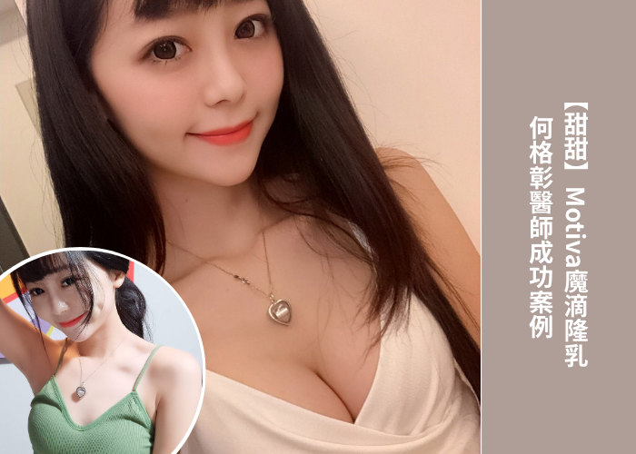 台中隆乳推薦丨格嘉內視鏡隆乳案例04